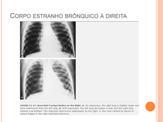 CORPO ESTRANHO BRÔNQUICO À DIREITA
 