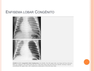 ENFISEMA LOBAR CONGÊNITO
 