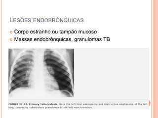 LESÕES ENDOBRÔNQUICAS
 Corpo estranho ou tampão mucoso
 Massas endobrônquicas, granulomas TB
 