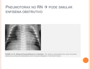PNEUMOTORAX NO RN  PODE SIMULAR
ENFISEMA OBSTRUTIVO
 