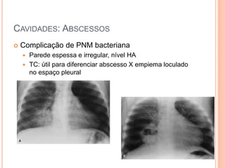 CAVIDADES: ABSCESSOS
 Complicação de PNM bacteriana
 Parede espessa e irregular, nível HA
 TC: útil para diferenciar abscesso X empiema loculado
no espaço pleural
 
