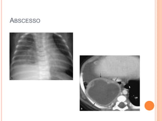 ABSCESSO
 