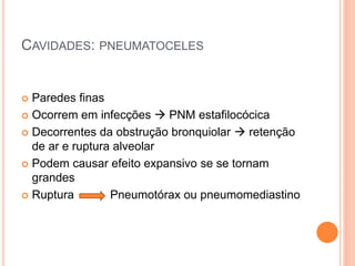 CAVIDADES: PNEUMATOCELES
 Paredes finas
 Ocorrem em infecções  PNM estafilocócica
 Decorrentes da obstrução bronquiolar  retenção
de ar e ruptura alveolar
 Podem causar efeito expansivo se se tornam
grandes
 Ruptura Pneumotórax ou pneumomediastino
 