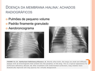 DOENÇA DA MEMBRANA HIALINA: ACHADOS
RADIOGRÁFICOS
 Pulmões de pequeno volume
 Padrão finamente granulado
 Aerobroncograma
 