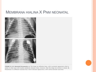 MEMBRANA HIALINA X PNM NEONATAL
 