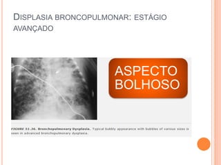 DISPLASIA BRONCOPULMONAR: ESTÁGIO
AVANÇADO
ASPECTO
BOLHOSO
 
