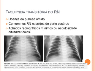 TAQUIPNEIA TRANSITÓRIA DO RN
 Doença do pulmão úmido
 Comum nos RN nascidos de parto cesáreo
 Achados radiográficos mínimos ou nebulosidade
difusa/retículos.
 