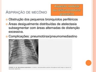 ASPIRAÇÃO DE MECÔNIO
 Obstrução dos pequenos bronquíolos periféricos
 Áreas desigualmente distribuídas de atelectasia
subsegmentar com áreas alternadas de distenção
excessiva.
 Complicações: pneumotórax/pneumomediastino
 