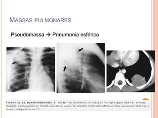 MASSAS PULMONARES
Pseudomassa  Pneumonia esférica
 
