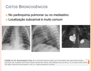 CISTOS BRONCOGÊNICOS
 No parênquima pulmonar ou no mediastino
 Localização subcarinal é muito comum
 