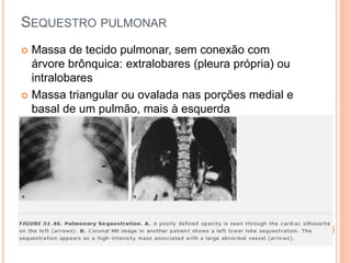 SEQUESTRO PULMONAR
 Massa de tecido pulmonar, sem conexão com
árvore brônquica: extralobares (pleura própria) ou
intralobares
 Massa triangular ou ovalada nas porções medial e
basal de um pulmão, mais à esquerda
 