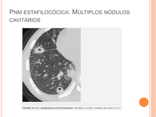 PNM ESTAFILOCÓCICA: MÚLTIPLOS NÓDULOS
CAVITÁRIOS
 
