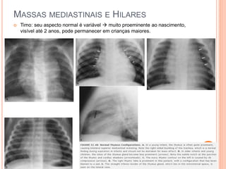 MASSAS MEDIASTINAIS E HILARES
 Timo: seu aspecto normal é variável  muito proeminente ao nascimento,
visível até 2 anos, pode permanecer em crianças maiores.
 