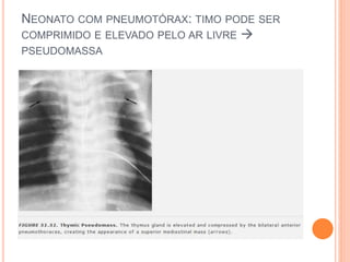 NEONATO COM PNEUMOTÓRAX: TIMO PODE SER
COMPRIMIDO E ELEVADO PELO AR LIVRE 
PSEUDOMASSA
 