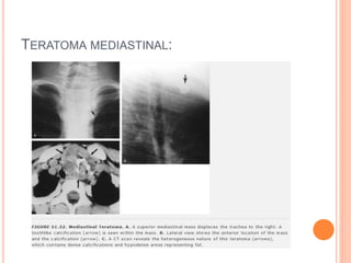 TERATOMA MEDIASTINAL:
 