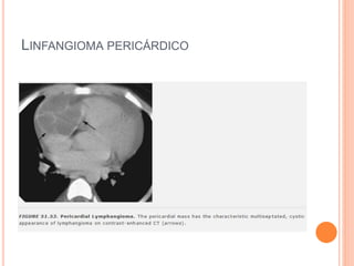 LINFANGIOMA PERICÁRDICO
 