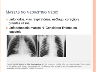 MASSAS NO MEDIASTINO MÉDIO
 Linfonodos, vias respiratórias, esôfago, coração e
grandes vasos.
 Linfadenopatia maciça  Considerar linfoma ou
leucemia
 