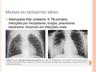 MASSAS NO MEDIASTINO MÉDIO
 Adenopatia hilar unilateral  TB primária,
infecções por micoplasma, fungos, pneumonia
bacteriana. Incomum em infecções virais
 