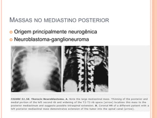 MASSAS NO MEDIASTINO POSTERIOR
 Origem principalmente neurogênica
 Neuroblastoma-ganglioneuroma
 