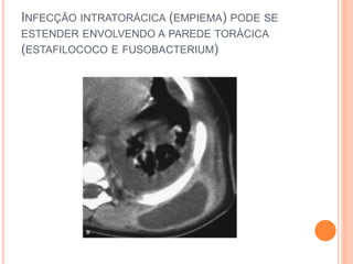 INFECÇÃO INTRATORÁCICA (EMPIEMA) PODE SE
ESTENDER ENVOLVENDO A PAREDE TORÁCICA
(ESTAFILOCOCO E FUSOBACTERIUM)
 