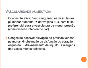 VASCULARIDADE AUMENTADA
 Congestão ativa: fluxo sanguíneo na vasculatura
pulmonar aumenta  derivações E-D, com fluxo
preferencial para a vasculatura de menor pressão
(comunicação interventricular)
 Congestão passiva: elevação da pressão venosa
pulmonar  obstrução ou disfunção do coração
esquerdo. Extravasamento de líquido  margens
dos vasos menos definidas.
 