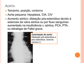 AORTA
 Tamanho, posição, contorno
 Aorta pequena: hipoplasia, CIA, CIV
 Aumento aórtico: dilatação pós-estenótica devido à
estenose da valva aórtica ou por fluxo sanguíneo
aumentado na insuficiência v. aórtica, PCA, PTA,
ou tetralogia de Fallot grave.
Coarctação da aorta:
Dilatação pré-estenótica e
pós estenótica: sinal do
número 3.
 