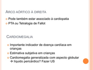 ARCO AÓRTICO À DIREITA
 Pode também estar associado à cardiopatia
 PTA ou Tetralogia de Fallot
CARDIOMEGALIA
 Importante indicador de doença cardíaca em
crianças
 Estimativa subjetiva em crianças
 Cardiomegalia generalizada com aspecto globular
 líquido pericárdico? Fazer US
 