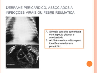 DERRAME PERICÁRDICO: ASSOCIADOS A
INFECÇÕES VIRAIS OU FEBRE REUMÁTICA
A. Silhueta cardíaca aumentada
com aspecto globular e
arredondado
B. A US é o melhor método para
identificar um derrame
pericárdico
 