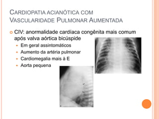 CARDIOPATIA ACIANÓTICA COM
VASCULARIDADE PULMONAR AUMENTADA
 CIV: anormalidade cardíaca congênita mais comum
após valva aórtica bicúspide
 Em geral assintomáticos
 Aumento da artéria pulmonar
 Cardiomegalia mais à E
 Aorta pequena
 