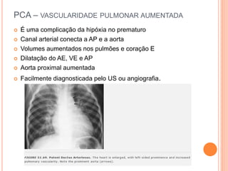PCA – VASCULARIDADE PULMONAR AUMENTADA
 É uma complicação da hipóxia no prematuro
 Canal arterial conecta a AP e a aorta
 Volumes aumentados nos pulmões e coração E
 Dilatação do AE, VE e AP
 Aorta proximal aumentada
 Facilmente diagnosticada pelo US ou angiografia.
 