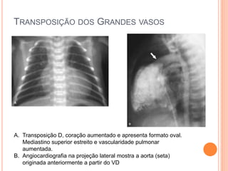 TRANSPOSIÇÃO DOS GRANDES VASOS
A. Transposição D, coração aumentado e apresenta formato oval.
Mediastino superior estreito e vascularidade pulmonar
aumentada.
B. Angiocardiografia na projeção lateral mostra a aorta (seta)
originada anteriormente a partir do VD
 