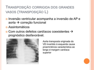 TRANSPOSIÇÃO CORRIGIDA DOS GRANDES
VASOS (TRANSPOSIÇÃO L)
 Inversão ventricular acompanha a inversão de AP e
aorta  correção funcional
 Assintomáticos
 Com outros defeitos cardíacos coexistentes 
prognóstico desfavorável.
Aorta transposta originada do
VD invertido à esquerda causa
proeminência característica ao
longo d margem cardíaca
superior
 