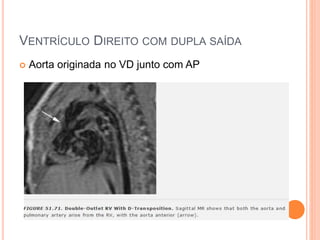 VENTRÍCULO DIREITO COM DUPLA SAÍDA
 Aorta originada no VD junto com AP
 