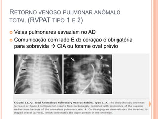 RETORNO VENOSO PULMONAR ANÔMALO
TOTAL (RVPAT TIPO 1 E 2)
 Veias pulmonares esvaziam no AD
 Comunicação com lado E do coração é obrigatória
para sobrevida  CIA ou forame oval prévio
 