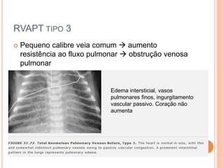 RVAPT TIPO 3
 Pequeno calibre veia comum  aumento
resistência ao fluxo pulmonar  obstrução venosa
pulmonar
Edema intersticial, vasos
pulmonares finos, ingurgitamento
vascular passivo. Coração não
aumenta
 