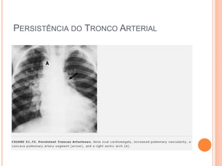 PERSISTÊNCIA DO TRONCO ARTERIAL
 
