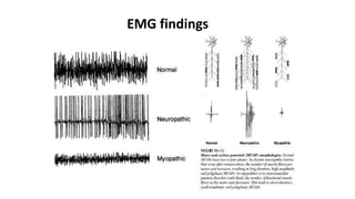 • Polyphasic, low
amplitude, short
duration MUPs with
voluntary activation
• Rapid recruitment of
MUPs w/ full
interference pattern
of low amplitude on
weak effort
EMG findings
 