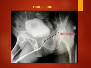 PROCEDURE
THE STRICTURE
 