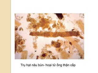 Trụ hạt nâu bùn- hoại tử ống thận cấp
 