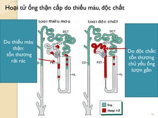Hoại tử ống thận cấp do thiếu máu, độc chất
54
Do thiếu máu
thận:
tổn thƣơng
rải rác
Do độc chất:
tổn thƣơng
chủ yếu ống
lƣợn gần
 