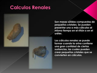 Calculos RenalesSon masas sólidas compuestas de pequeños cristales. Se pueden presentar uno o más cálculos al mismo tiempo en el riñón o en el uréter.Los cálculos renales se puede formar cuando la orina contiene una gran cantidad de ciertas sustancias, las cuales pueden crear pequeños cristales que se convierten en cálculos.