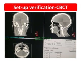 • CBCT CORRECTIONS
Set-up verification-CBCT
24
 