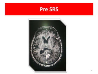 Pre SRS
39
 