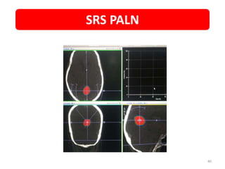 SRS PALN
40
 