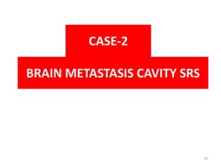 BRAIN METASTASIS CAVITY SRS
CASE-2
42
 
