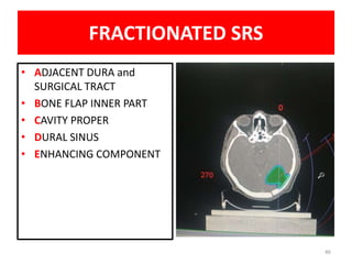 46
FRACTIONATED SRS
• ADJACENT DURA and
SURGICAL TRACT
• BONE FLAP INNER PART
• CAVITY PROPER
• DURAL SINUS
• ENHANCING COMPONENT
 