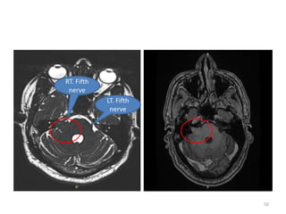 LT. Fifth
nerve
RT. Fifth
nerve
50
 