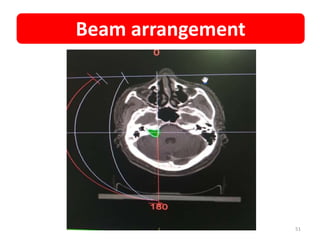 Beam arrangement
51
 