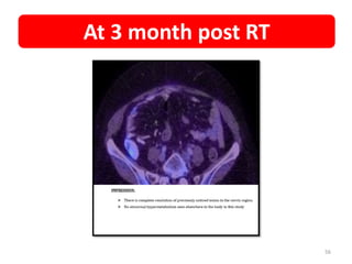 56
At 3 month post RT
 