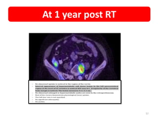 57
At 1 year post RT
 
